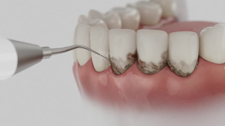 Trusted Dental Crowns And Bridges service in Oquawka, IL - Dentist Open Now